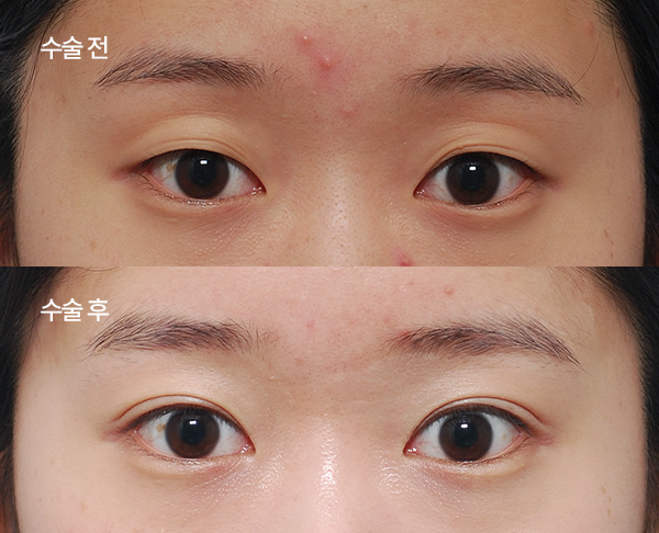 sub-fat grafting bna (4)