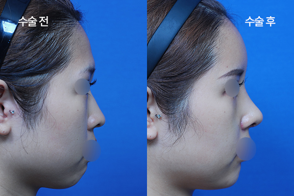 sub-fat grafting bna (5)