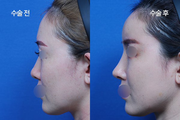 sub-fat grafting bna (7)