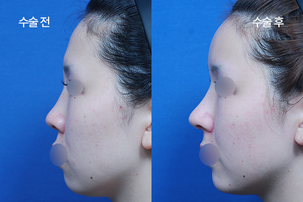 sub-fat grafting bna (8)