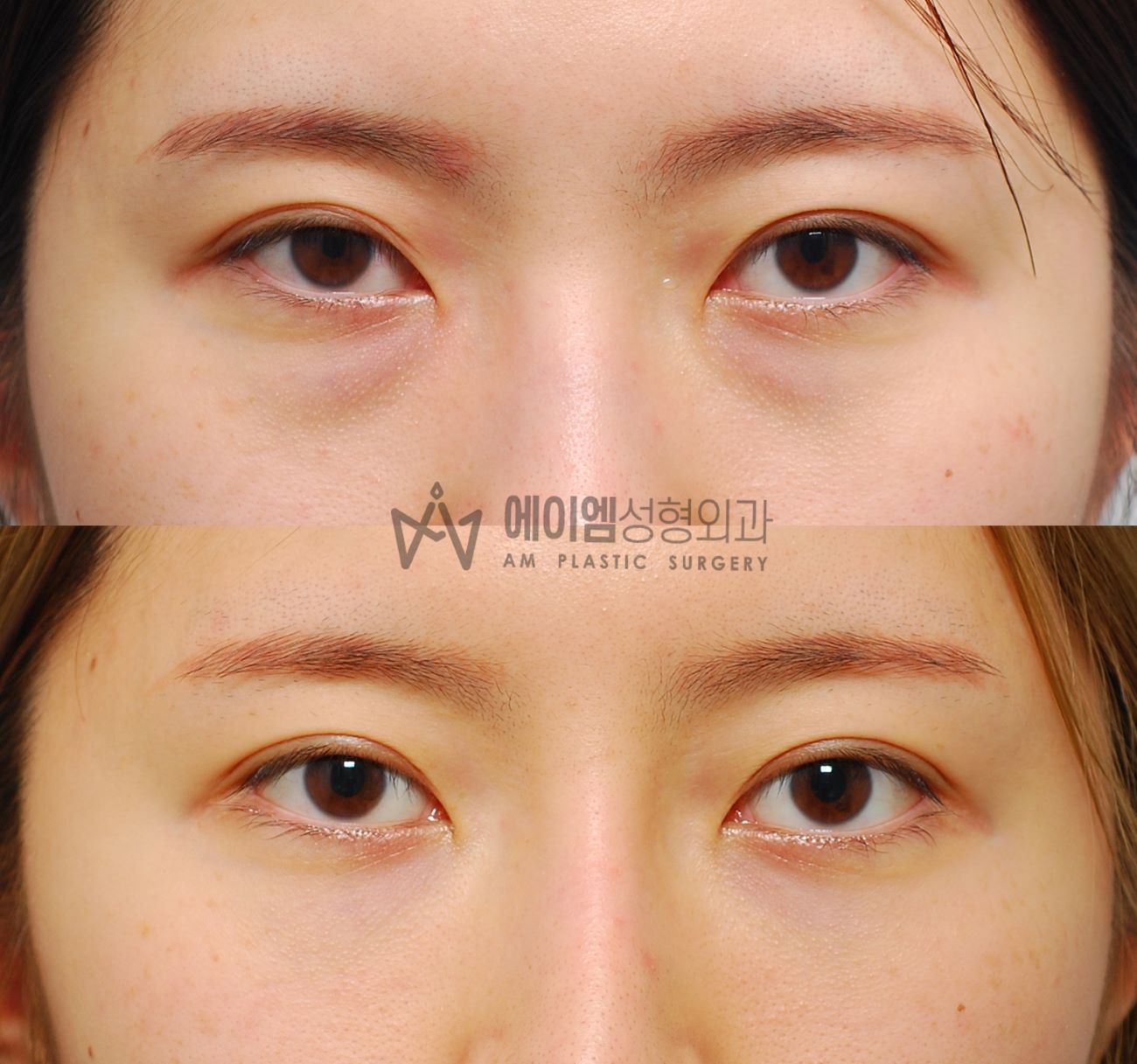 눈밑지방재배치 1년9개월 후기