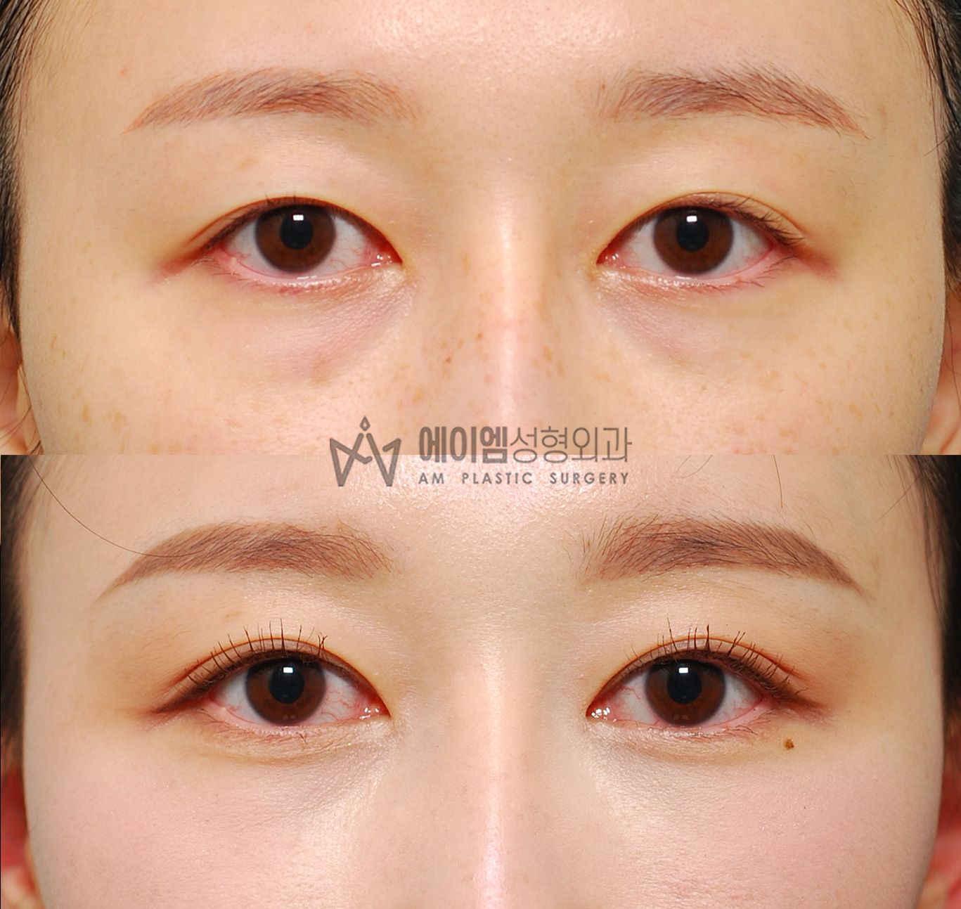 눈밑지방재배치 3개월 후기 