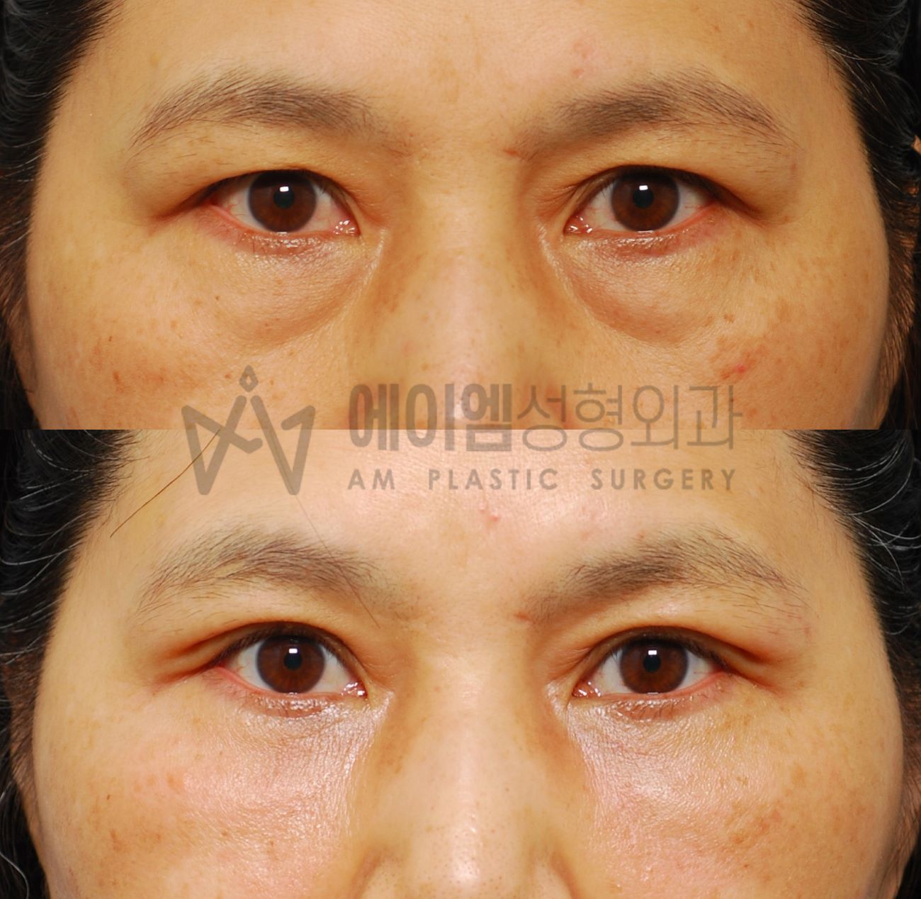 중년 눈밑지방재배치 3개월 후기