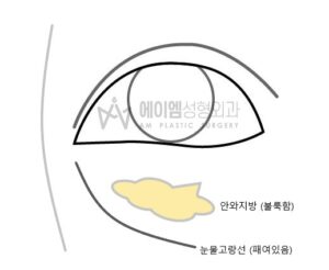 패인 눈물고랑선, 불룩한 눈밑지방