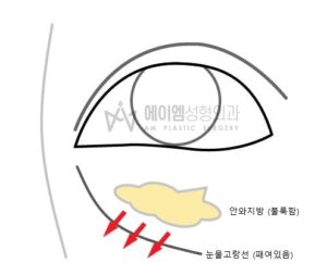 눈밑지방재배치 수술방법