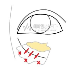눈밑지방재배치 수술법