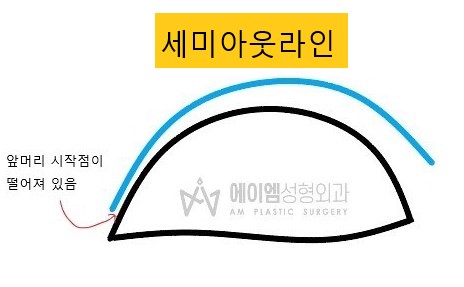 세미아웃라인 쌍꺼풀