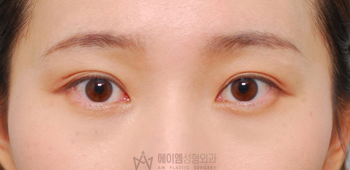 쌍꺼풀 한쪽만 수술, 한쪽 눈 쌍수 우측, 수술 후 3개월
