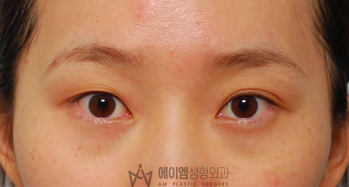 쌍꺼풀 한쪽만 수술, 한쪽 눈 쌍수 우측, 수술 전