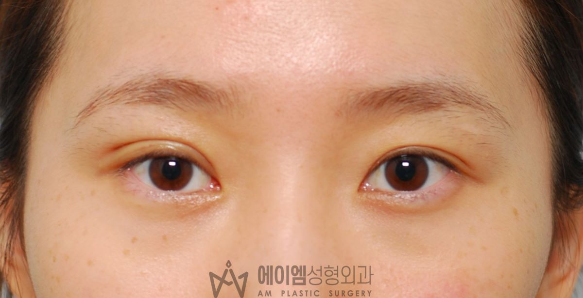 쌍꺼풀 한쪽만 수술, 한쪽 눈 쌍수 우측, 수술 후 4일