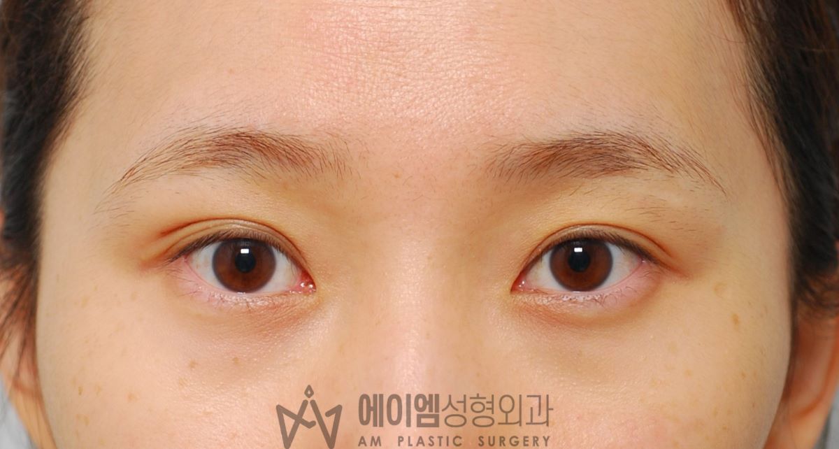 쌍꺼풀 한쪽만 수술, 한쪽 눈 쌍수 우측, 수술 후 1개월