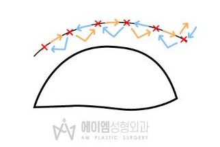 쌍수 한쪽만 수술 방법