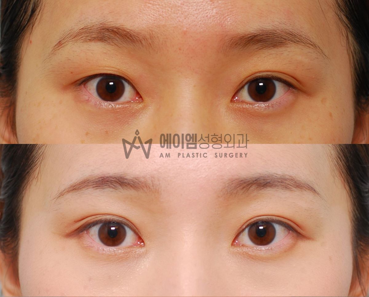 쌍수 한쪽만, 쌍꺼풀 한쪽만 수술, 한쪽 눈 쌍수, 수술 전후 비교 3개월차